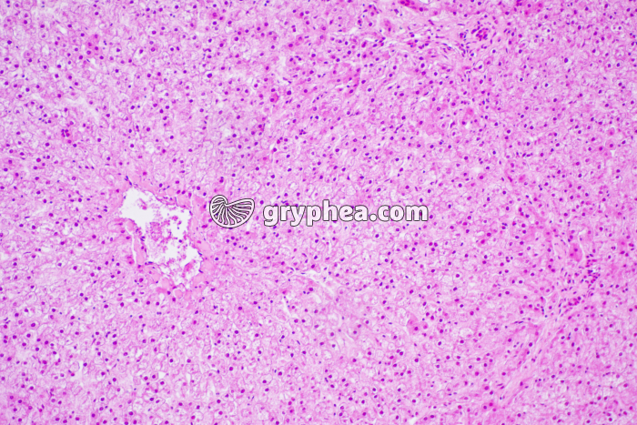 Foie diabétique stéatose x40 - gryphea.org